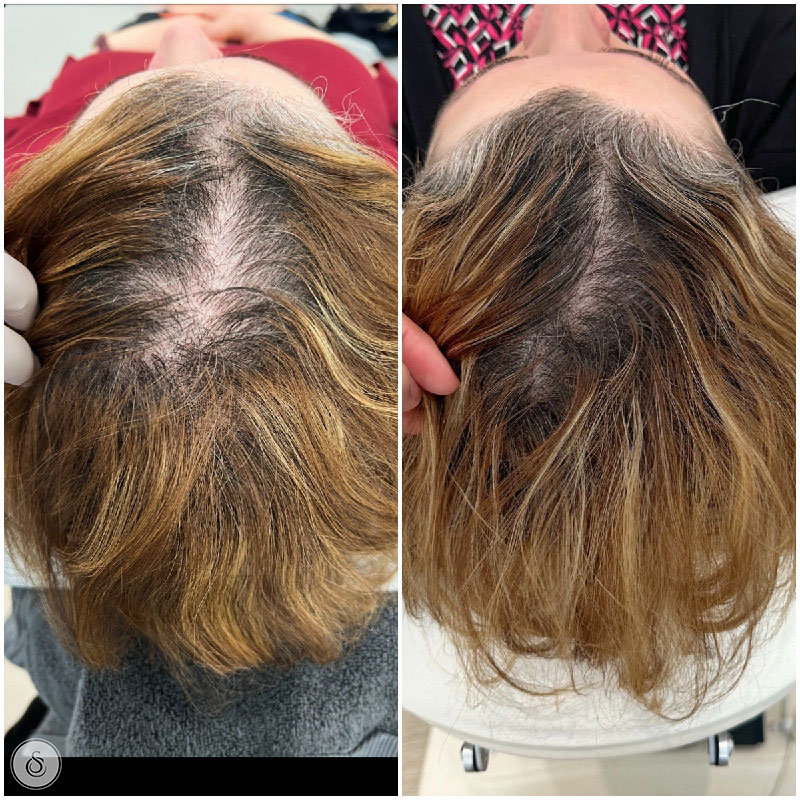 Sarasin Clinic haarfiller vrouw voor en na closeup